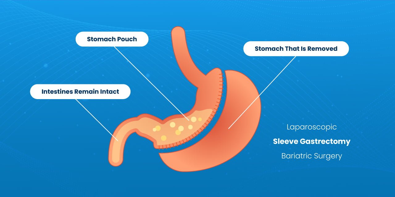 Laparoscopic Sleeve Gastrectomy CIGIS Hospital