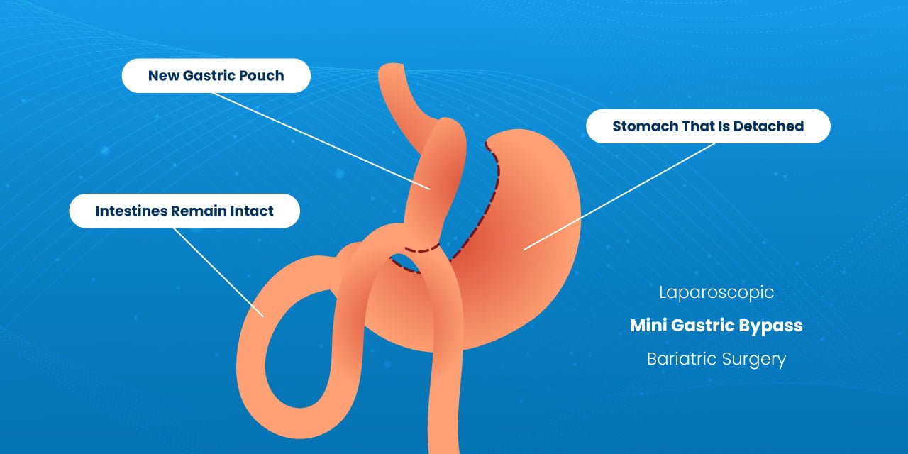 mini-gastric-bypass-cigis-hospital