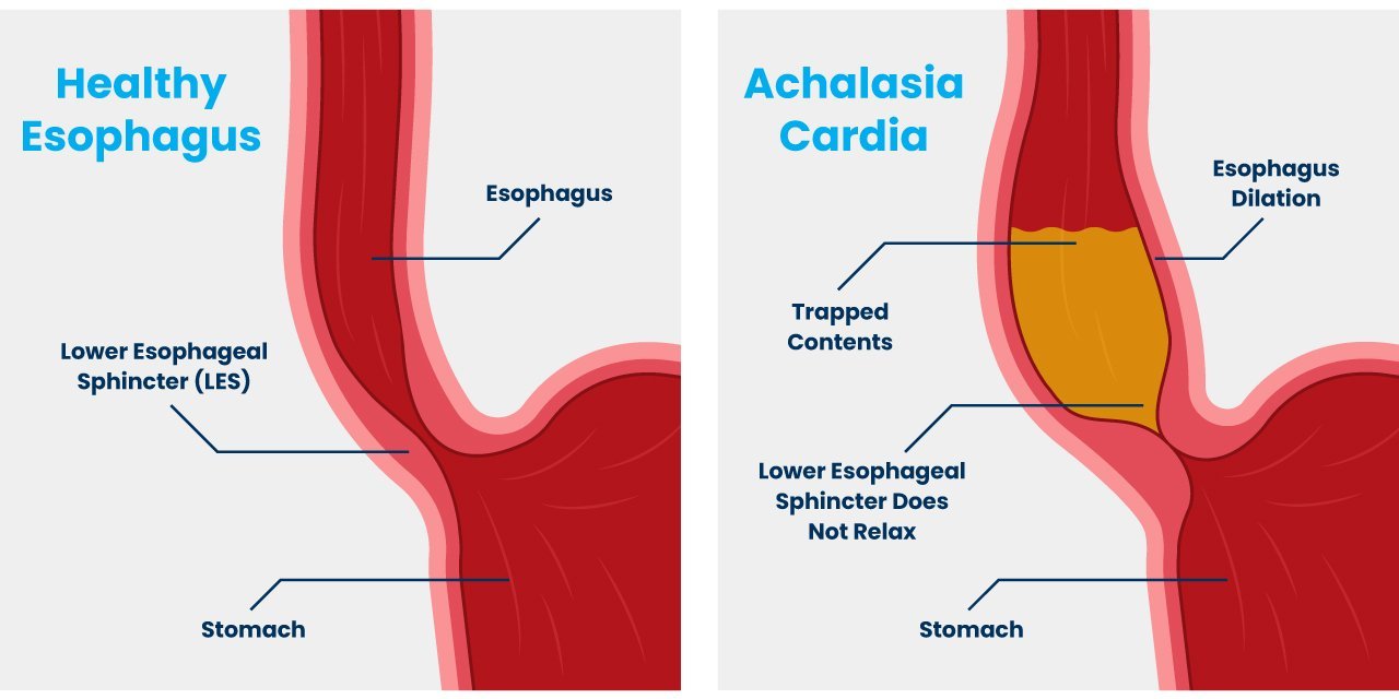 Achalasia Cardia – CIGIS Hospital